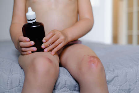 Children injury. Deep scratches on the skin on the kids knee. Wounds, scratches, abrasions on the child leg. Bottle of antiseptic and sponges to clean the woundの写真素材