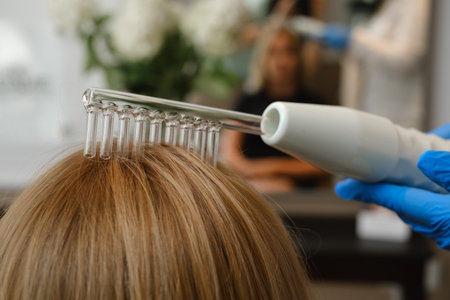 Doctor treats head skin with special dermatology equipment system, hairloss and trichology concept Woman with the Darsonval device at the trichologist. Electrotherapy stimulates treatmentの写真素材