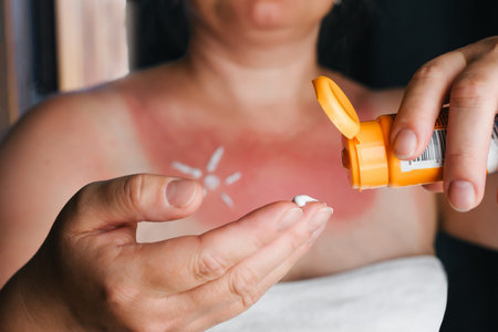 Woman Applying Soothing Cream on Hand for Sunburned Red Skinの写真素材