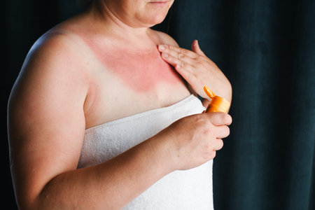 Woman applying cream to severe red sunburn on chestの写真素材