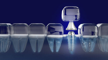 The Dental implant 3d rendering image for medical content.