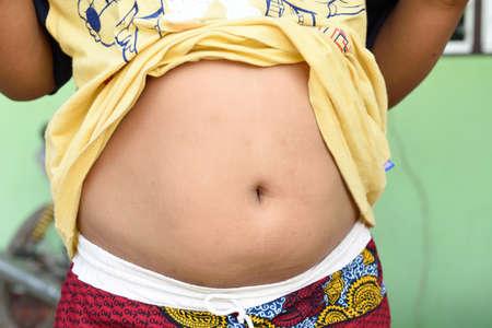 Child Obesityの写真素材