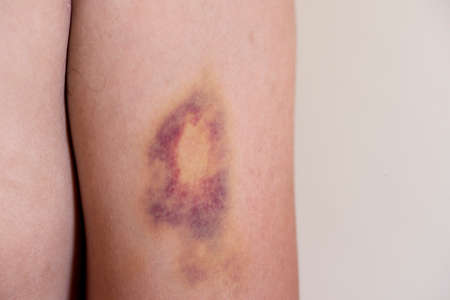 Bruise on man arm. Injection bruises on arm.の写真素材