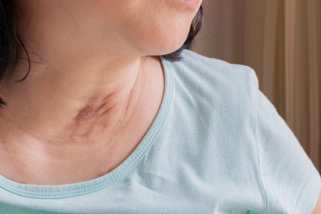 Asian woman neck puncture wound due to neck abscessの写真素材