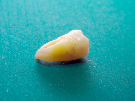 Problems with teeth, cavities, tooth inflammation.の写真素材