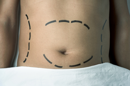 high-angle shot of the abdomen of a young caucasian man who is about to have a plastic surgery or a liposuction with surgery lines marked around his belly and flanksの写真素材