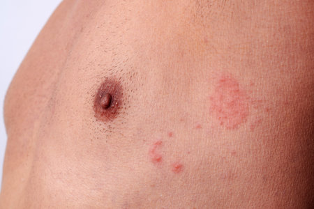 close-up view of the chest of a man affected by shingles, where red rashes and small blisters appear...