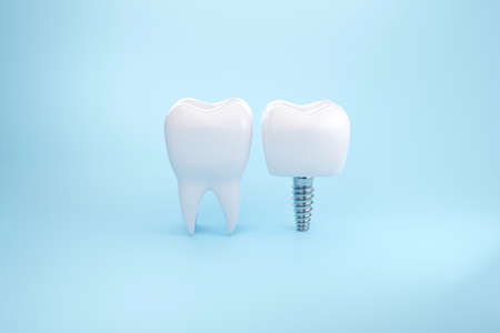 Clean Healthy tooth and dental Implant on blue background. 3D renderingの写真素材