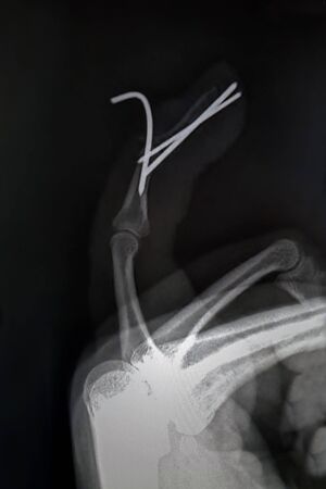 X-ray finger and Fingers iron surgeryの写真素材