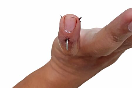 Bone fracture in finger or Finger surgery or finger splintの写真素材