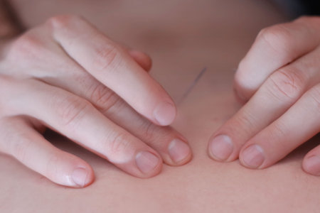 Body care , stimulating an acupuncture needle on the back of a patient.Acupuncture, is used to...