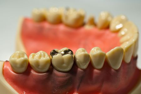 Shiny smooth golden dental inlayの写真素材