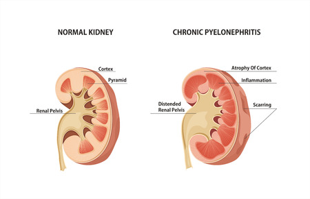 Normal kidney and Chronic Pyelonephritis.のイラスト素材