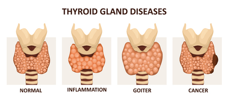 Thyroid gland diseasesの写真素材