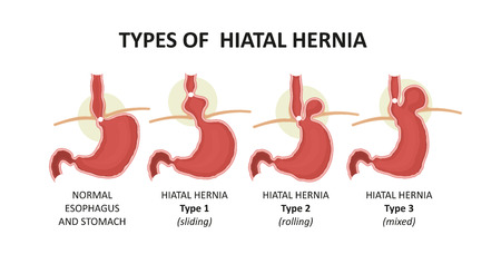 types of hiatal herniaのイラスト素材
