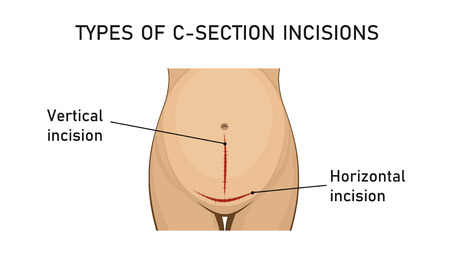 Types of incisions in cesarean deliveryのイラスト素材