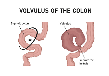 volvulus of the colonのイラスト素材