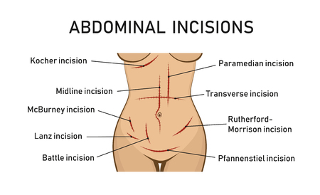 Abdominal incisions. Surgery. Vector illustrationのイラスト素材