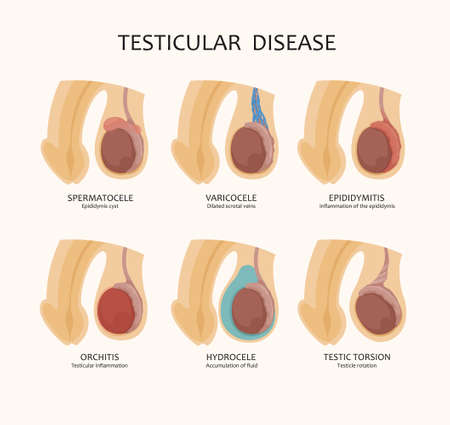 Various testicular diseases - such as varicocele, orchitis and others