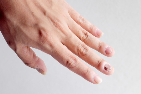 Fungus Infection on Nails Hand, Finger with onychomycosis. - soft focusの写真素材