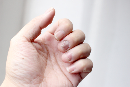 Fungus Infection on Nails Hand, Finger with onychomycosis. - soft focusの写真素材