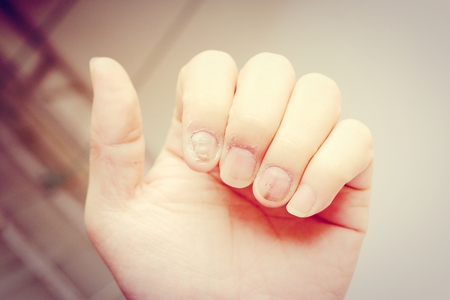 Fungus Infection on Nails Hand, Finger with onychomycosis. - soft focusの写真素材