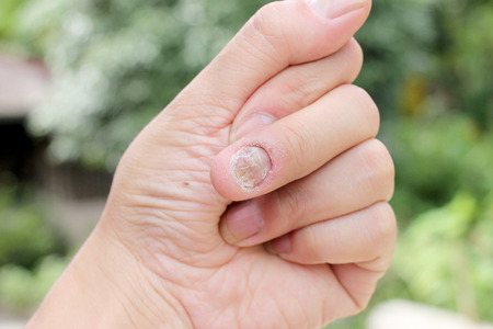 Fungus Infection on Nails Hand, Finger with onychomycosis, A toenail fungus. - soft focusの写真素材