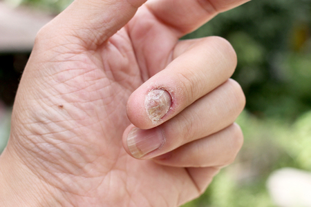 Fungus Infection on Nails Hand, Finger with onychomycosis, A toenail fungus. - soft focusの写真素材