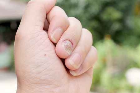 Fungus Infection on Nails Hand, Finger with onychomycosis, A toenail fungus. - soft focusの写真素材