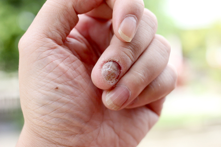 Fungus Infection on Nails Hand, Finger with onychomycosis, A toenail fungus. - soft focusの写真素材