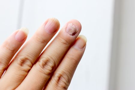 Fungus Infection on Nails Hand, Finger with onychomycosis. - soft focusの写真素材