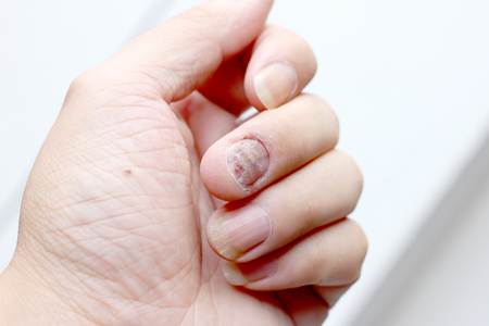 Fungus Infection on Nails Hand, Finger with onychomycosis. - soft focusの写真素材
