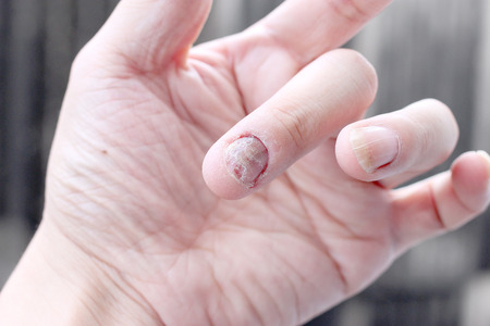 Fungus Infection on Nails Hand, Finger with onychomycosis. - soft focusの写真素材
