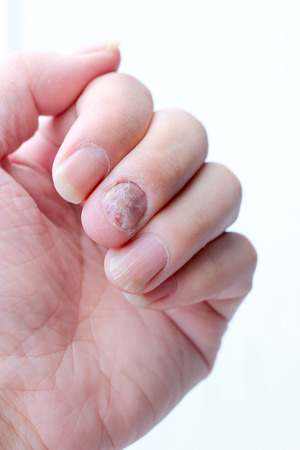 Fungus Infection on Nails Hand, Finger with onychomycosis. - soft focusの写真素材
