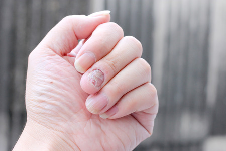 Fungus Infection on Nails Hand, Finger with onychomycosis. - soft focusの写真素材