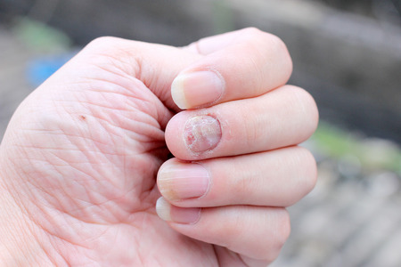 Fungus Infection on Nails Hand, Finger with onychomycosis. - soft focusの写真素材