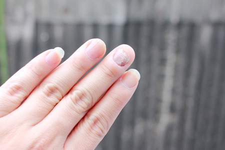 Fungus Infection on Nails Hand, Finger with onychomycosis. - soft focusの写真素材