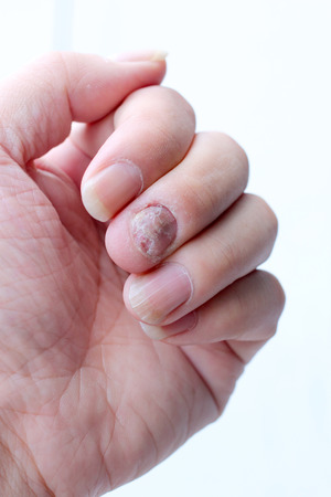 Fungus Infection on Nails Hand, Finger with onychomycosis. - soft focusの写真素材