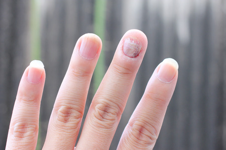 Fungus Infection on Nails Hand, Finger with onychomycosis. - soft focusの写真素材