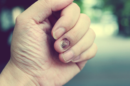 Fungal nail infection and damage on human hand. Finger with onychomycosis