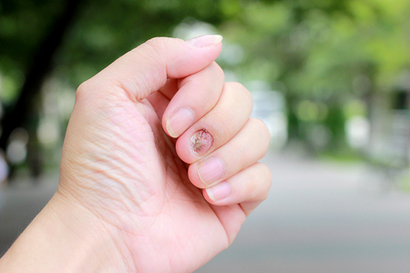 Fungal nail infection and damage on human hand. Finger with onychomycosisの写真素材