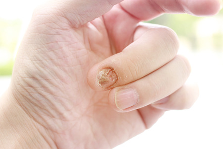 Fungal nail infection and damage on human hand. Finger with onychomycosisの写真素材