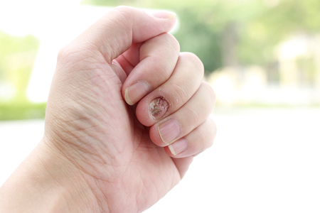Fungal nail infection and damage on human hand. Finger with onychomycosisの写真素材