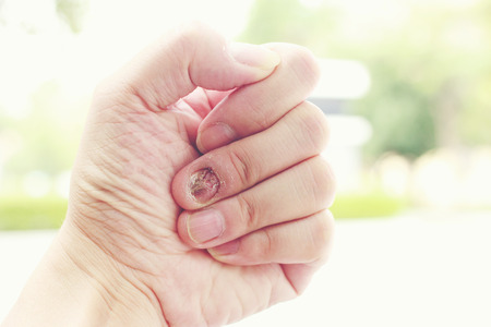 Fungal nail infection and damage on human hand. Finger with onychomycosisの写真素材