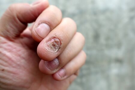 Close up of fungus nail infection. Fungal infection on nails hand, finger with onychomycosis, damage on human hand on gray concrete wall background. Disease and Symptom concept.の写真素材