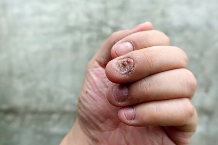 Close up of fungus nail infection. Fungal infection on nails hand, finger with onychomycosis, damage on human hand on gray concrete wall background. Disease and Symptom concept.の写真素材
