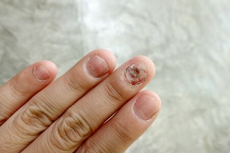 Close up of fungus nail infection. Fungal infection on nails hand, finger with onychomycosis, damage on human hand on gray concrete wall background. Disease and Symptom concept.の写真素材