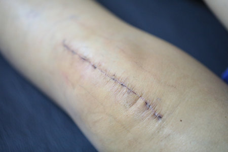 Surgical wound on the human arm, closeup of a wound after surgeryの写真素材