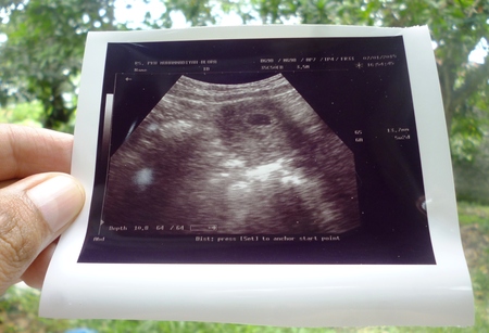 Photo of an ultrasound sonogram of an unborn baby