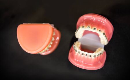 Orthodontic, denture closeup, black backgroundの写真素材